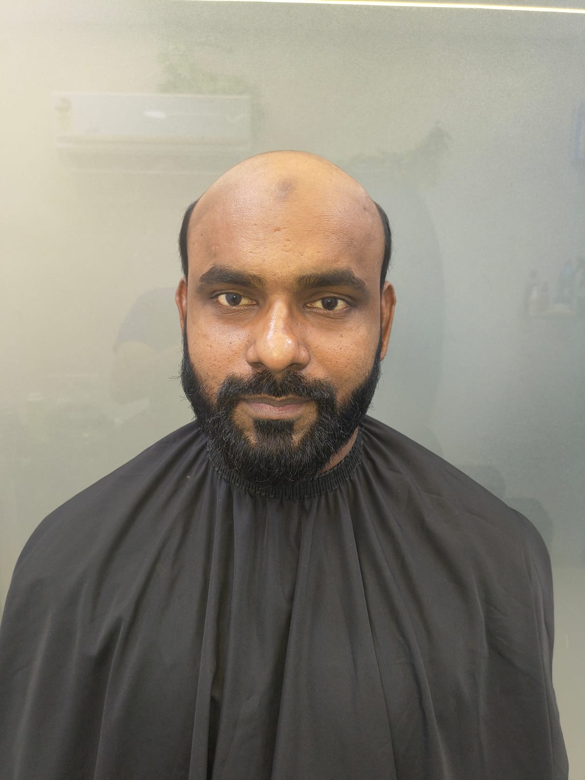Before – Complete Baldness